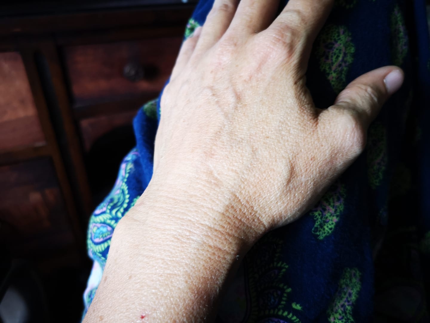 Healing Lockjaw, Infection and Tetanus? Ligaments, Tendons and nerves